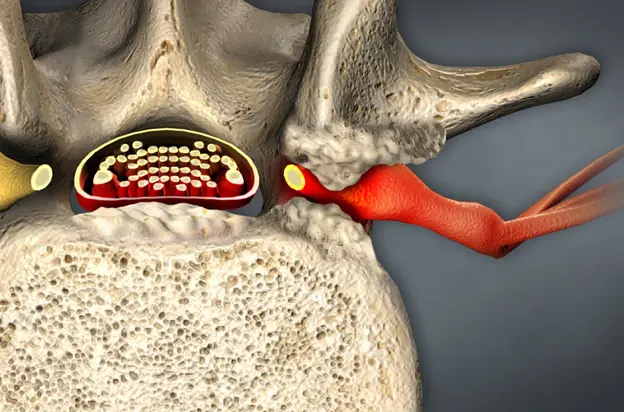 stenoza kanału kręgowego