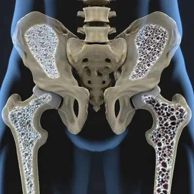 Osteoporoza — przyczyny, objawy, leczenie